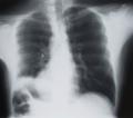 das Bild zu 'lung cancer' auf Deutsch